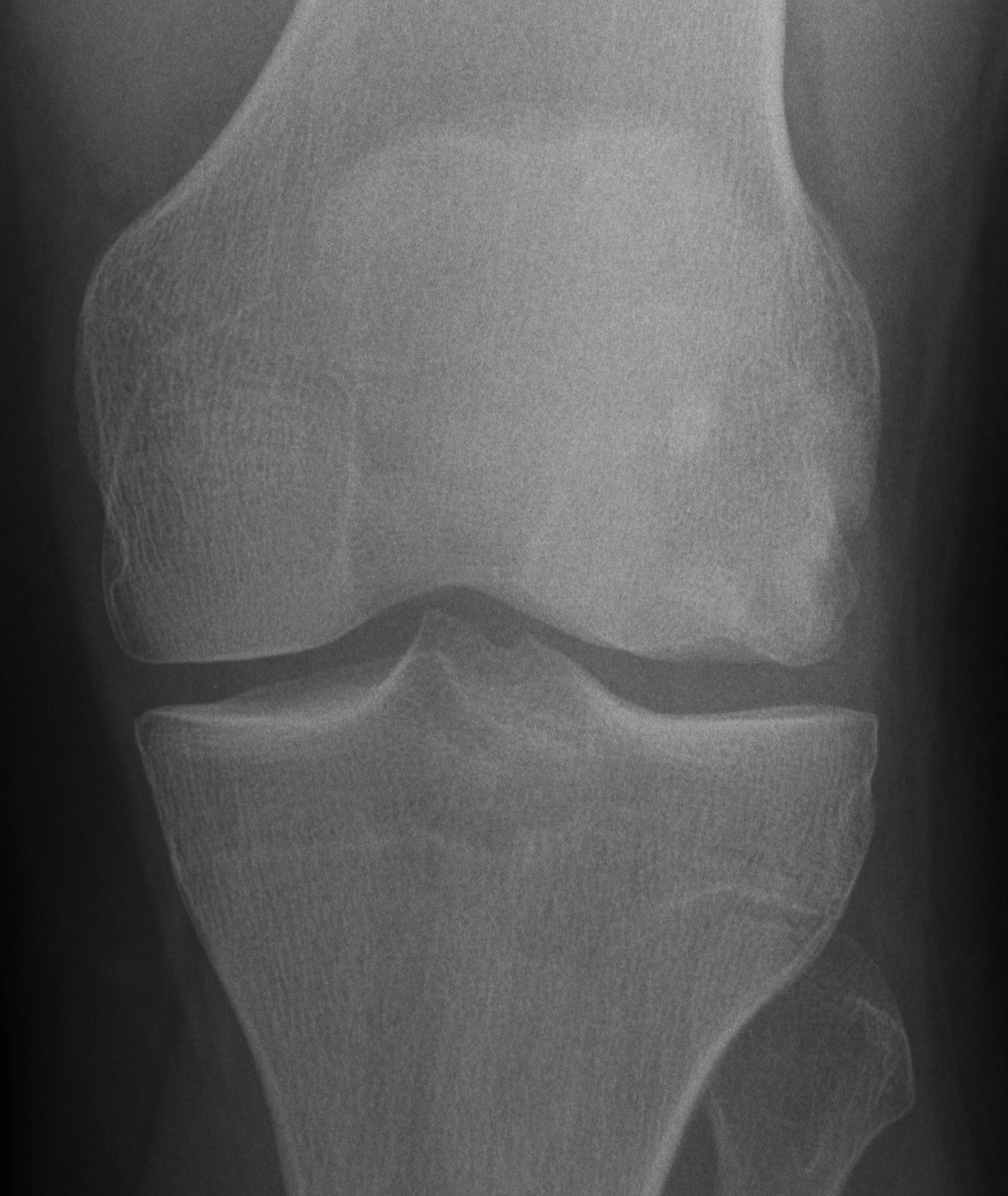 Knee OCD Lateral Femur AP